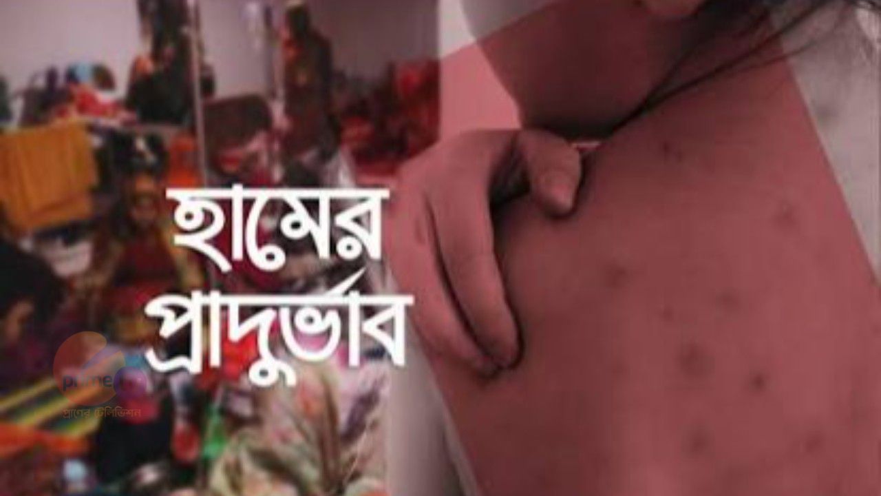 হামের উপসর্গে আরও ৫ শিশুর মৃত্যু, মোট প্রাণহানি বেড়ে ৮২৫